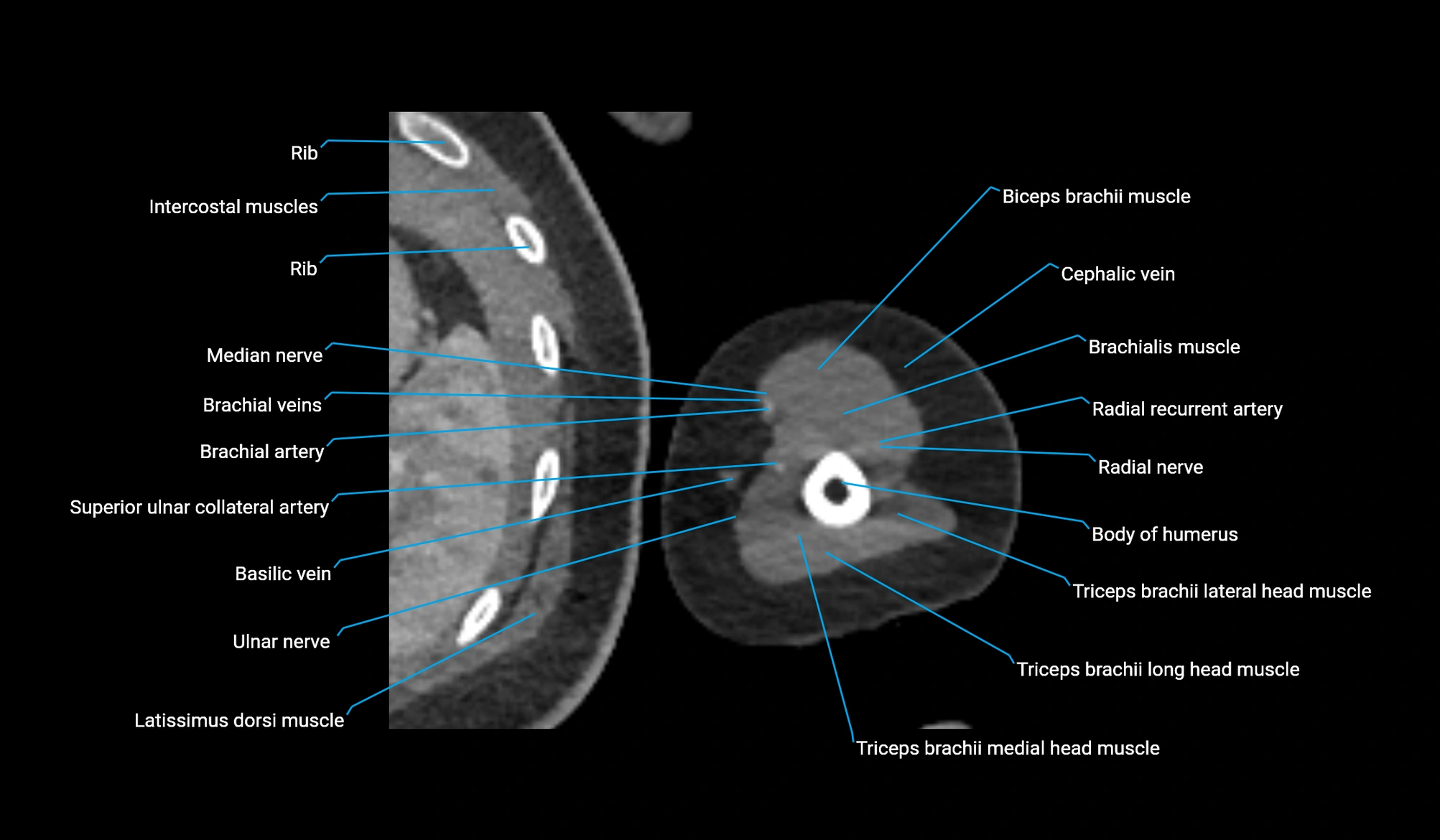 CT upper arm axial  cross sectional anatomy labelled radiology image -00302.webp